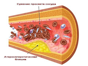 Всемирный день тромбоза